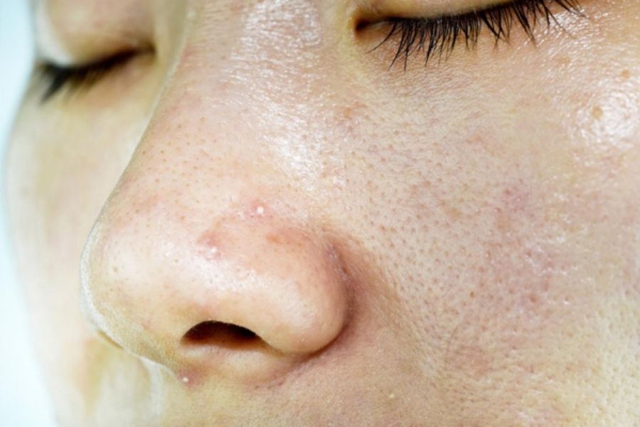 Da mặt tiết nhiều dầu gây khó chịu và dễ nổi mụn